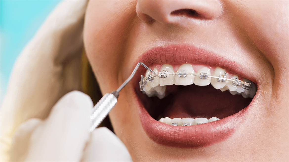 Treatment With Brackets
